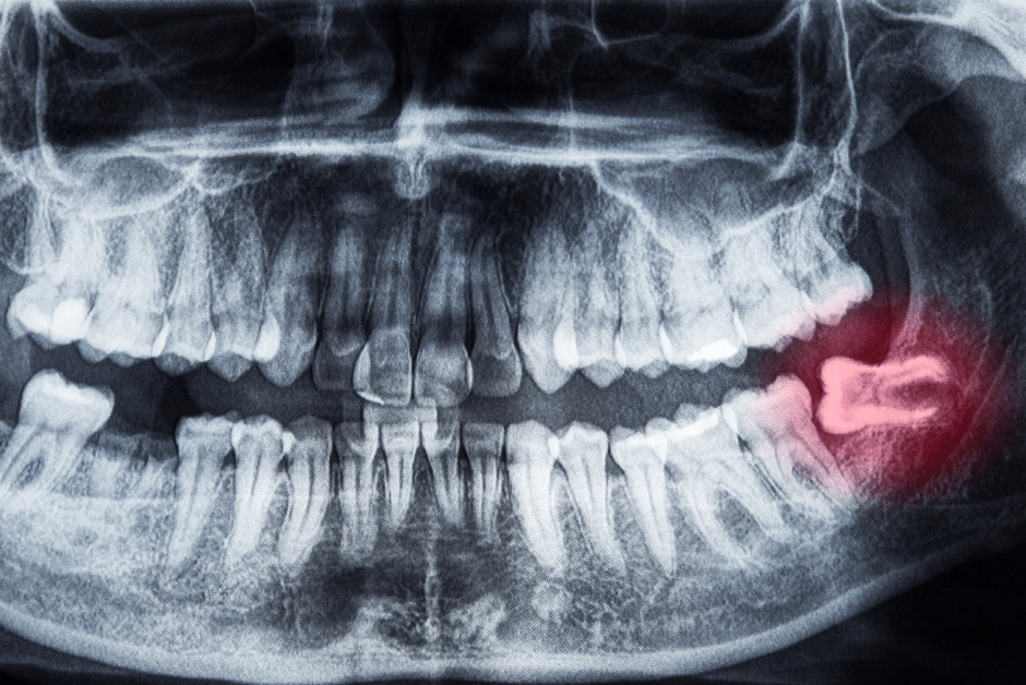 ภาพ X-Ray ฟันคุด สำหรับการ ผ่าฟันคุด ผ่าตัดฟันคุด หรือ ถอนฟันคุด