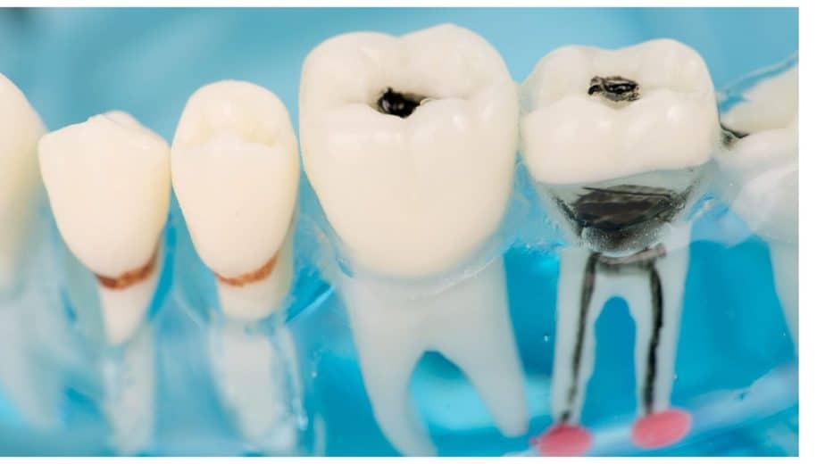ฟันผุ จะทำให้เนื้อฟันเปลี่ยนเป็นสีดำ และอาจลุกลามไปจนถึงโพรงประสาทฟัน