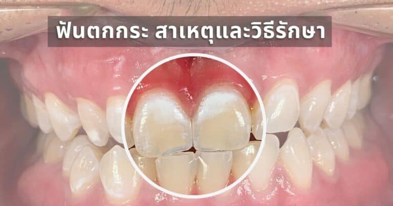 ฟันตกกระ สาเหตุและวิธีรักษา