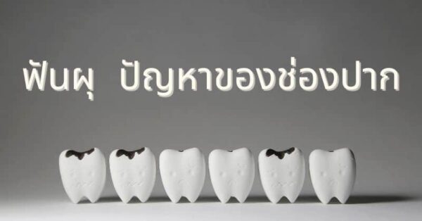 ฟันผุ ปัญหาของช่องปาก