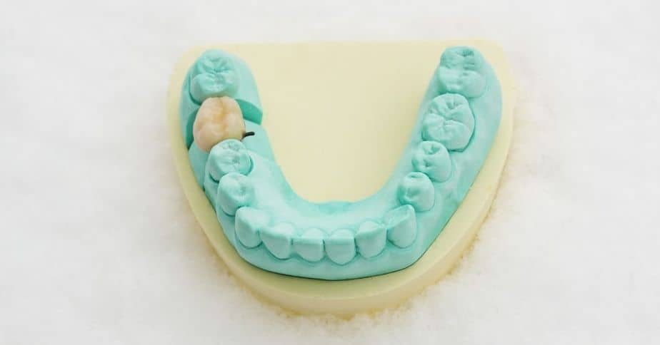 ฟันปลอมแบบติดแน่น - ประเภทครอบฟัน