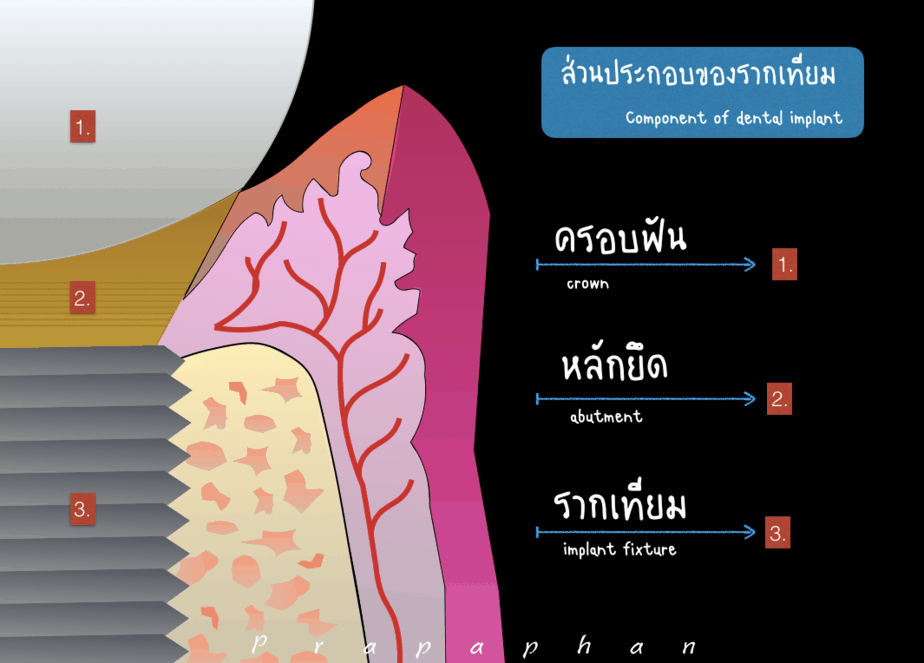 ส่วนประกอบของ รากฟันเทียม