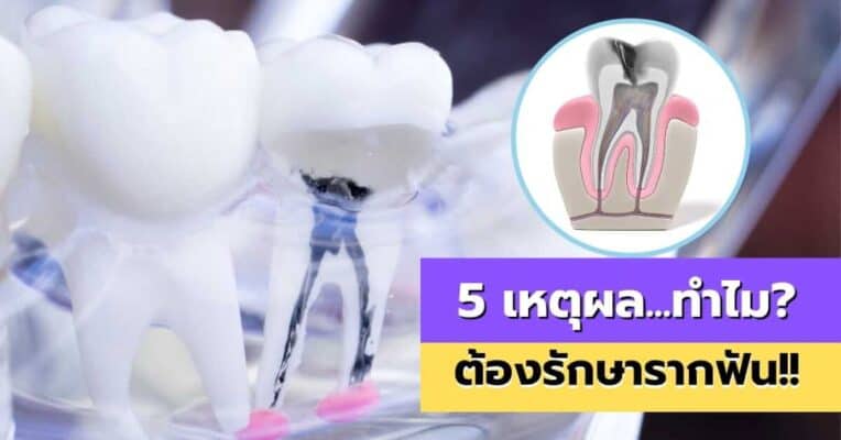5 เหตุผล ทำไมต้องรักษารากฟัน