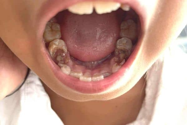 กรณีที่ต้องทำ ครอบฟันน้ำนม ครอบฟันเด็ก ใน เด็กที่มีฟันผุลุกลามมาก