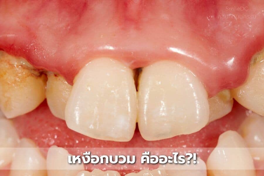 เหงือกบวม คืออะไร?