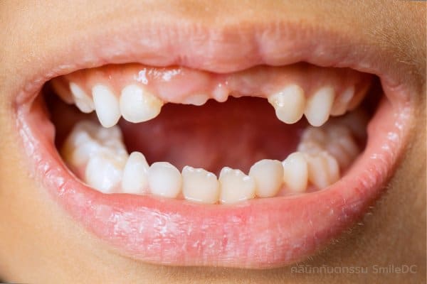 ครอบฟันเด็กช่วยสร้างความมั่นใจ - ความประหม่าจากการสูญเสียฟันหน้า