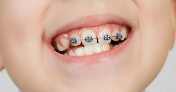 จัดฟันน้ำนมในเด็ก คื่ออะไร เริ่มทำจัดฟันเด็ก ได้เมื่อไหร่?