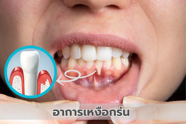 อาการเหงือกร่น