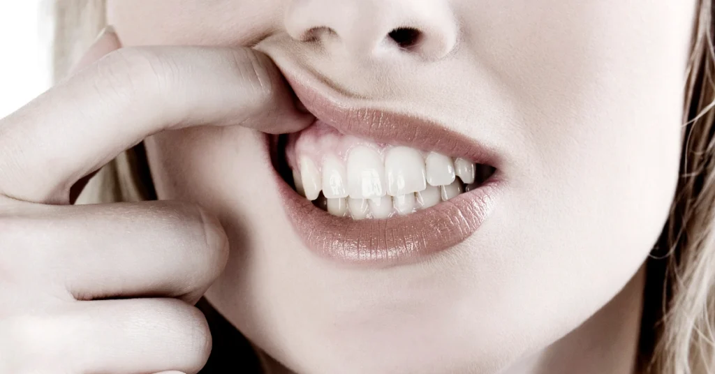 Receding Gum - Feature Image